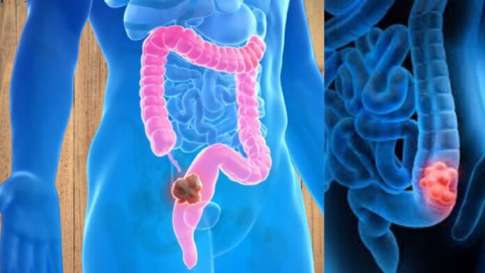 colorectal cancer : 5 early warning indicators of colorectal cancer and here's how to protect yourself