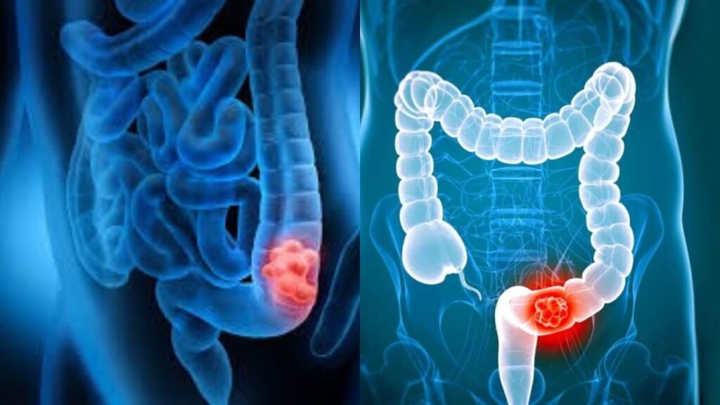 colorectal cancer : 5 early warning indicators of colorectal cancer and here's how to protect yourself